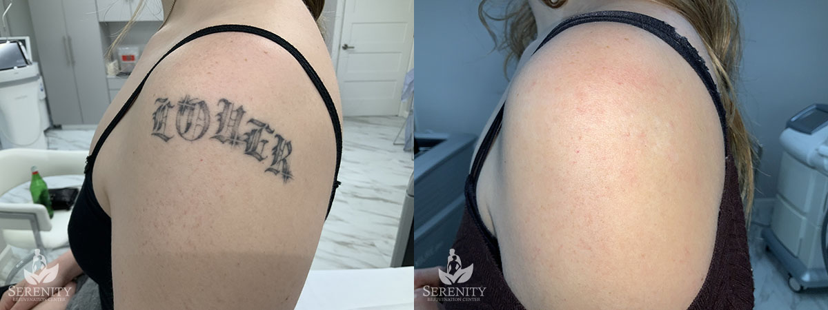 PicoSure Laser Tattoo Removal in Seattle & Bellevue