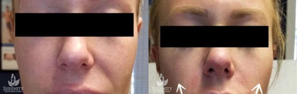 Dermal Fillers before and after photo by Dr. Stephen O’Connell in Bellevue, WA