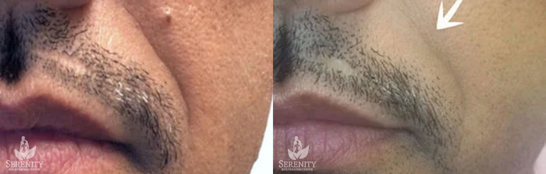 Dermal Fillers before and after photo by Dr. Stephen O’Connell in Bellevue, WA