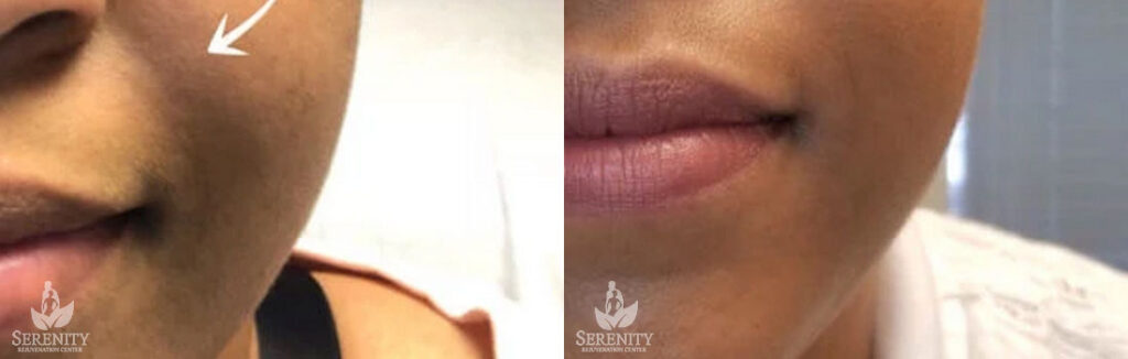 Lip Fillers in Seattle, Bellevue & Redmond