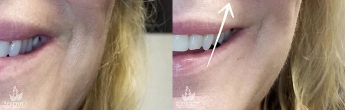 Facial Fillers for Wrinkle Reduction in Seattle & Bellevue