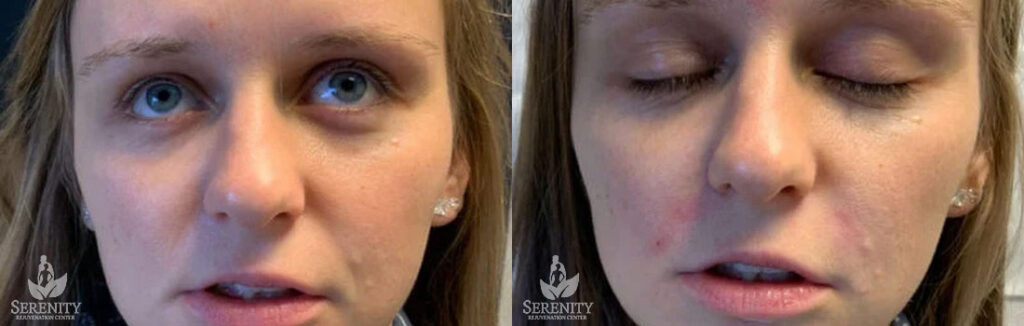 Dermal Fillers in Bellevue, Seattle & Redmond, WA