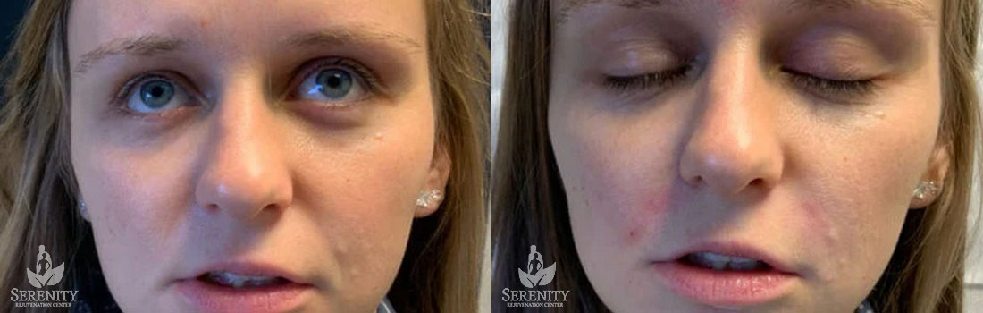 Dermal Fillers in Bellevue, Seattle & Redmond, WA