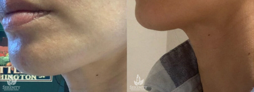 Potenza RF Microneedling in Bellevue & Seattle