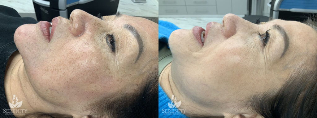 PicoFocus Laser Skin Rejuvenation Seattle, Hyperpigmentation Treatment Bellevue, Skin Glow Redmond