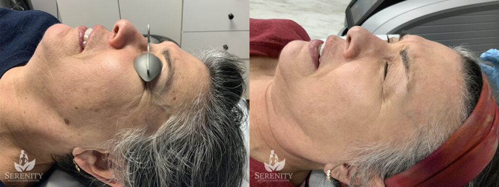 PicoFocus before and after photo by Dr. Stephen O’Connell in Bellevue, WA