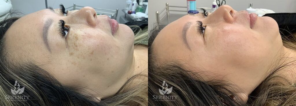PicoFocus Skin Rejuvenation in Bellevue & Seattle