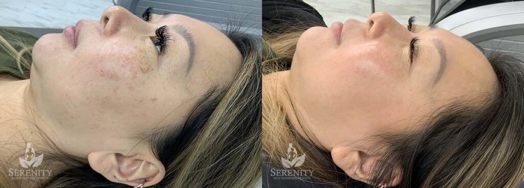 PicoSure® Pro Focus before and after photo by Dr. Stephen Oconnell in Bellevue WA