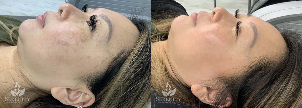 PicoFocus Skin Rejuvenation Seattle, Pigmentation Treatment Kirkland, Laser Therapy Bellevue