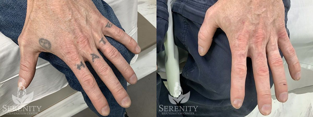 Best PicoSure Tattoo Removal in Bellevue & Seattle
