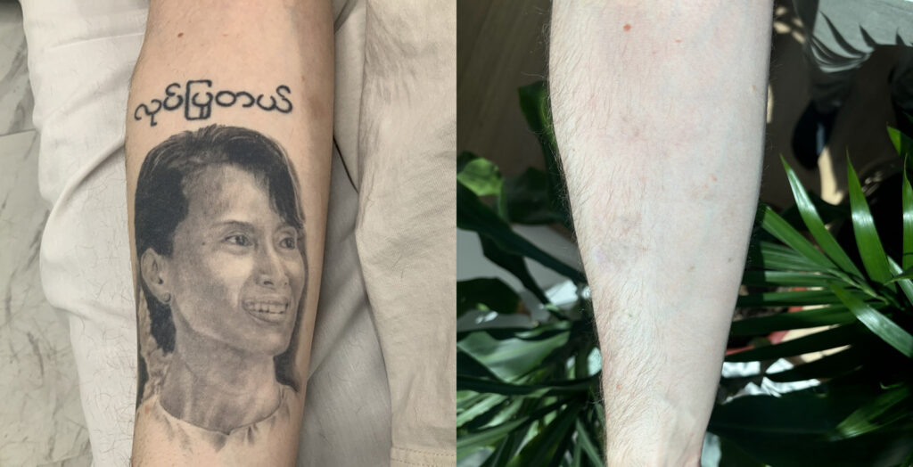 Advanced PicoSure Tattoo Removal in Bellevue & Seattle