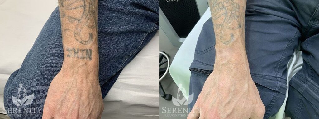 Fast PicoSure Tattoo Removal in Bellevue & Seattle