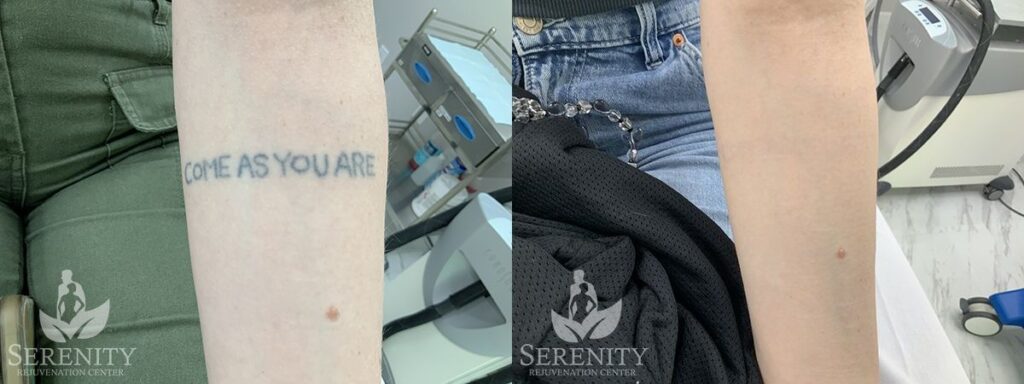 Effective PicoSure Tattoo Removal in Bellevue & Seattle