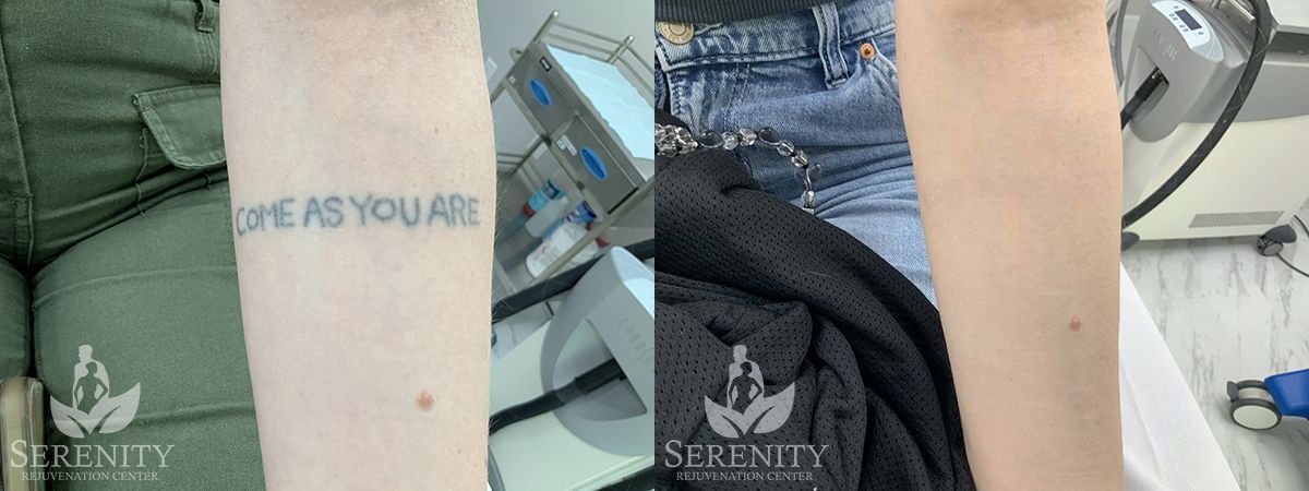 Effective PicoSure Tattoo Removal in Bellevue & Seattle