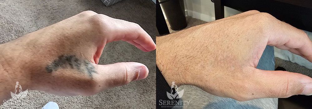 PicoSure Tattoo Removal in Bellevue, Seattle & Redmond