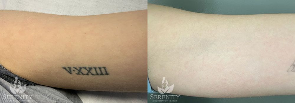 Laser Tattoo Removal in Bellevue, Seattle & Redmond