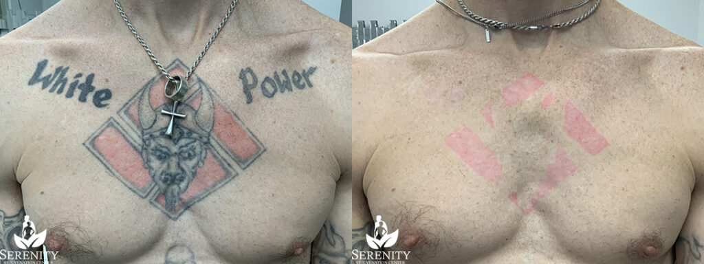 PicoSure Tattoo Removal in Bellevue & Seattle