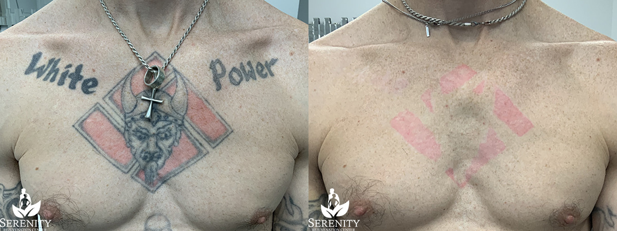 PicoSure Tattoo Removal in Bellevue & Seattle
