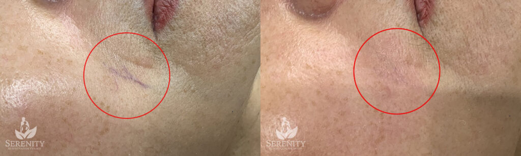 IPL Photofacial Kirkland, Skin Tone Correction Bellevue, Sun Damage Treatment Seattle