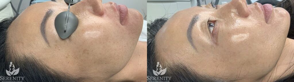 Seattle PicoFocus Skin Treatment, Bellevue Skin Rejuvenation