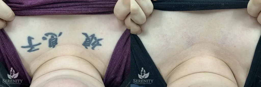 Seattle Tattoo Removal, Bellevue PicoSure Tattoo Removal