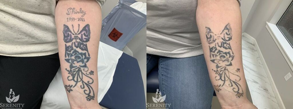Picosure Tattoo Removal before and after photo by Dr. Stephen Oconnell in Bellevue WA
