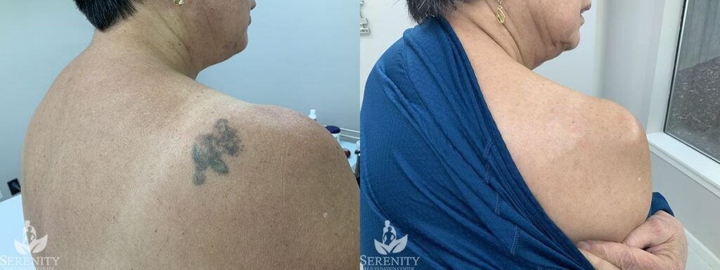 Picosure Tattoo Removal before and after photo by Dr. Stephen Oconnell in Bellevue WA
