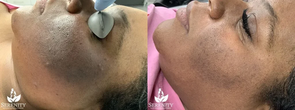 Picosure Focus Removal before and after photo by Dr. Stephen Oconnell in Bellevue WA