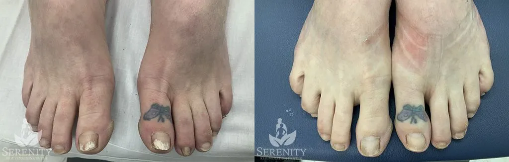 Toe nail fungus before and after photo by Dr. Stephen Oconnell in Bellevue WA