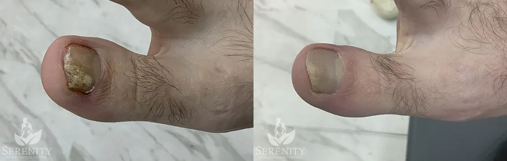 Toe nail fungus before and after photo by Dr. Stephen Oconnell in Bellevue WA