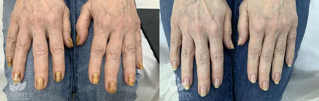 Onychomycosis before and after photo by Dr. Stephen Oconnell in Bellevue WA