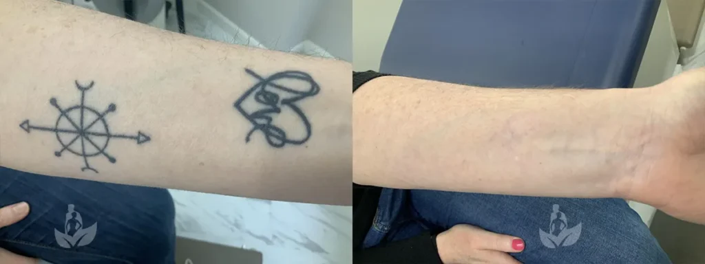 Seattle Tattoo Removal Work Before After Gallery Serenity Rejuvenation Center