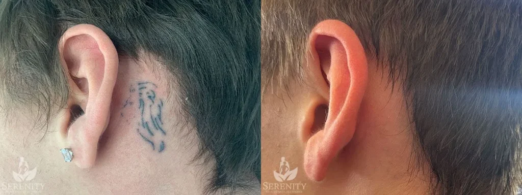Tattoo Removal before and after photo by Dr. Stephen Oconnell in Bellevue WA