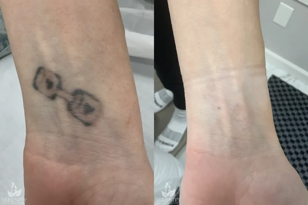 PicoSure Tattoo Removal before and after photo by Dr. Stephen Oconnell