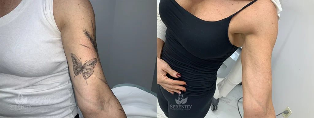 Seattle Arm Tattoo Removal Work Before After Gallery Serenity Rejuvenation Center
