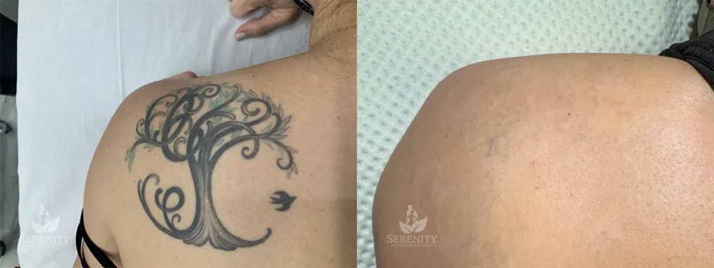 Seattle Tattoo Removal Before After Gallery Serenity Rejuvenation Center