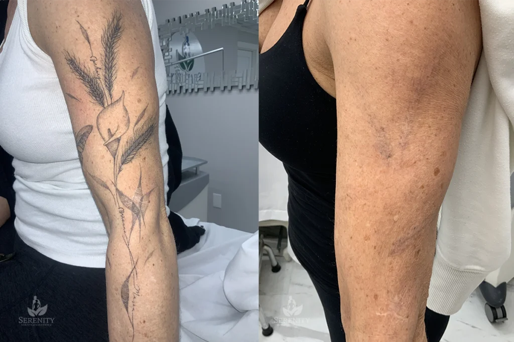 Seattle Tattoo Removal Work Before After Gallery Serenity Rejuvenation Center Case Study