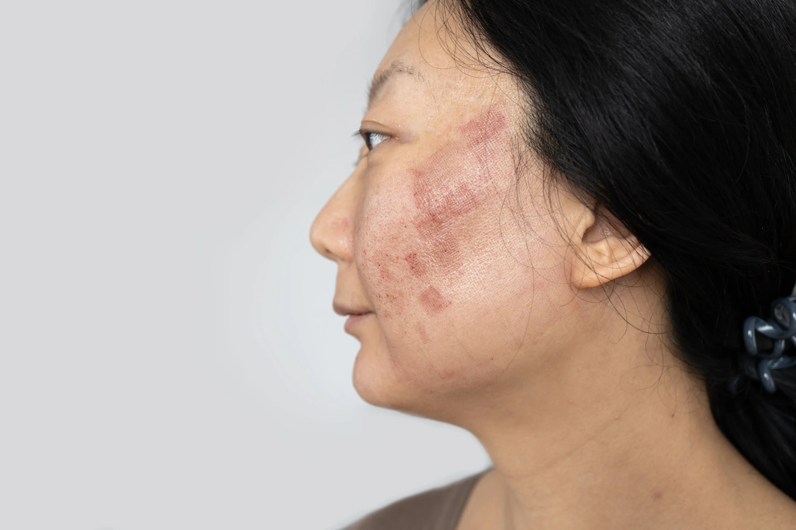 melasma treatment in seattle