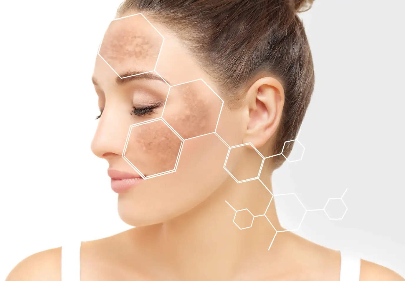what causes melasma