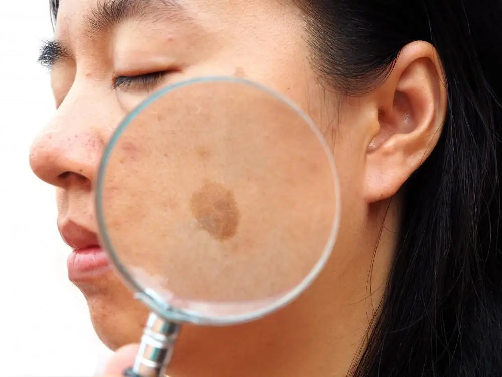 why picosure is the superior melasma solution